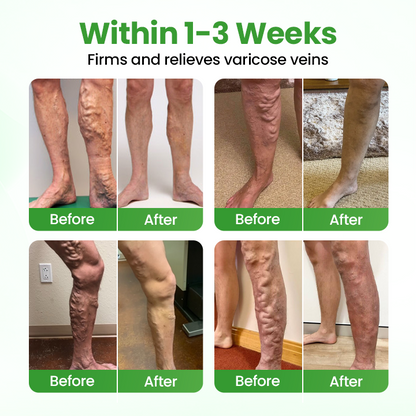 Healrize® VeinHeal Microneedle Patch.