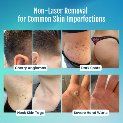 Timilk® SpotlessPro 7-Day Advanced Blemish & Tag Eraser